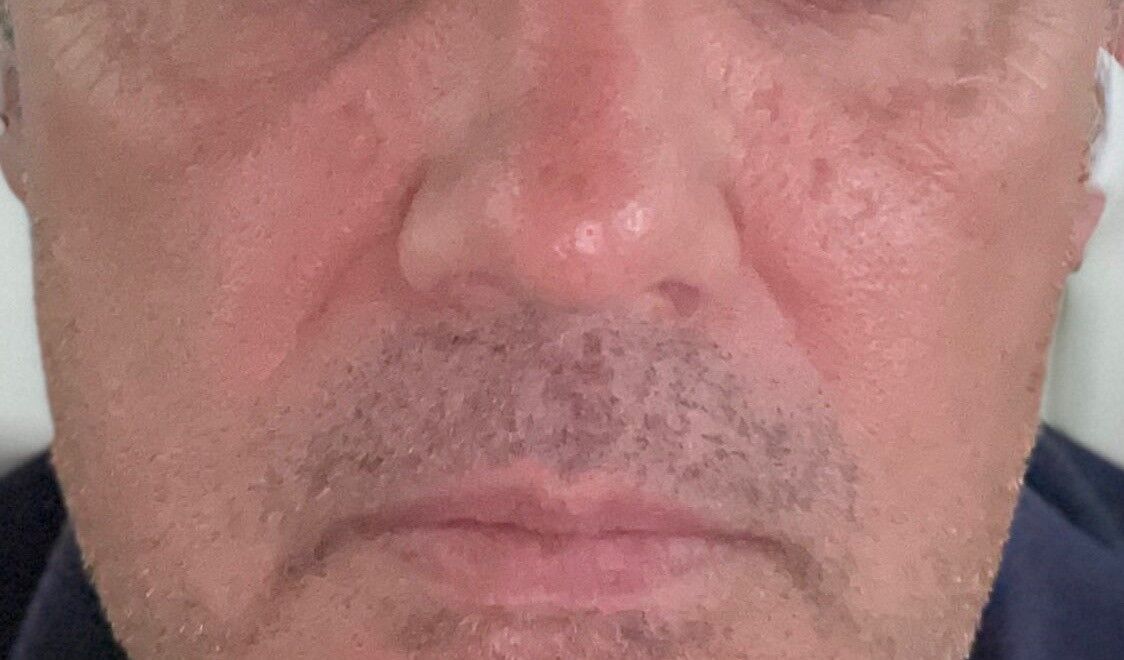 Aging male faces benefit from rejuvenation, too